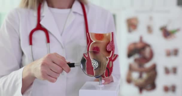 医生持有放大镜和直肠有痔疮的解剖模型 痔疮的治疗 — 图库视频影像