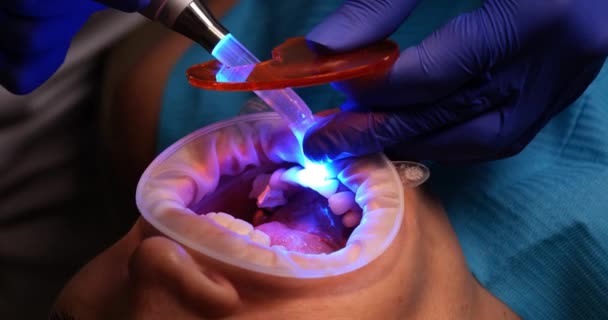 牙医在补牙后使用紫外光灯 在现代牙科诊所和镶嵌镶面的妇女 — 图库视频影像
