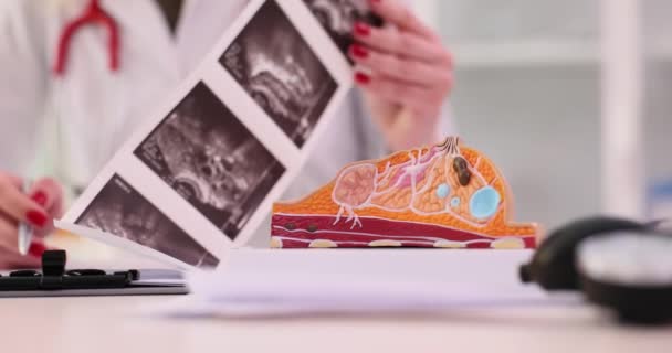 Mamografický Lékař Zkoumá Snímky Pacienta Fibroadenomatózou Výsledek Ultrazvuku Diagnóza Ultrazvuku — Stock video