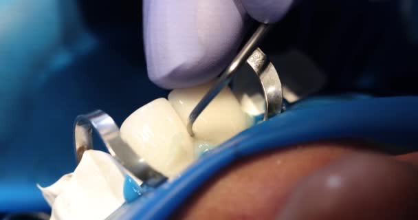 歯科オフィスの患者は 金属小売業者と入れ歯やベニヤをインストールします 歯科医は歯のゲルを取除きます — ストック動画
