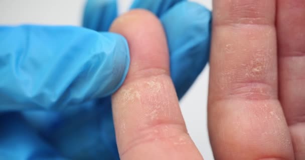 Peeling Palms Fingers Allergy Fingers Man Eczema Peeling Due Dermatitis — Stock Video