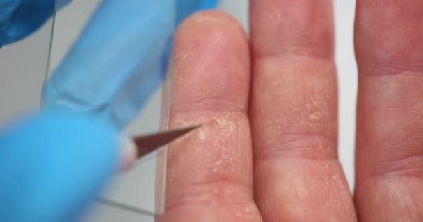 Dermatologue Prend Raclage Peau Problématique Des Mains Des Patients Procédé — Video