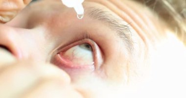 Man instilling eye drops from allergies closeup 4k movie slow motion. Viral conjunctivitis treatment concept