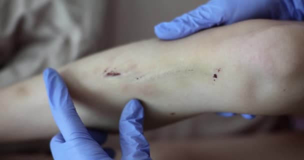 Doctor Examining Abrasions Bruises Child Leg Closeup Movie Slow Motion — Vídeo de stock