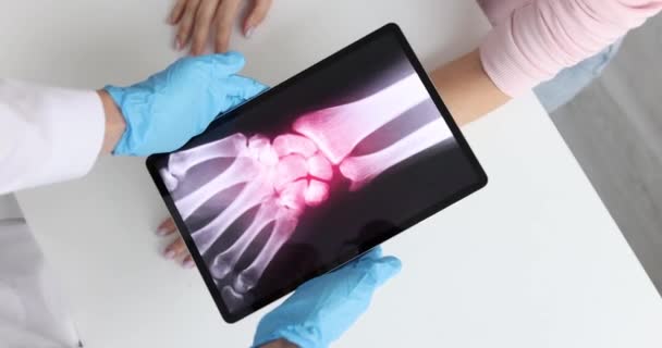 炎症を伴う手の電子X線 手の概念の痛みの原因 — ストック動画