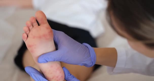 Doktor Dermatolog Zkoumá Červenou Vyrážku Nohou Dítěte Detailní Film Koncept — Stock video