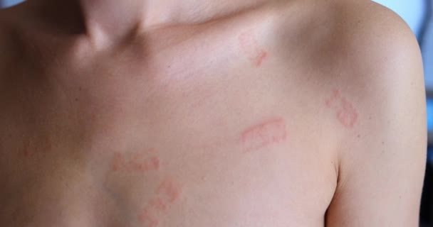 Rode Vlekken Huid Van Vrouw Closeup Film Allergische Eczeem Diagnose — Stockvideo