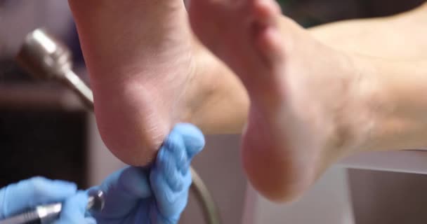 Podiatrist Polishing Skin Soles Feet Closeup Movie Treatment Cracked Feet — Wideo stockowe