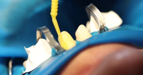 高級歯科の特別なフォトポリマーの詰物および黄色い棒の使用 歯科クリニックにおける怒りに対する歯の白化プロセス — ストック動画