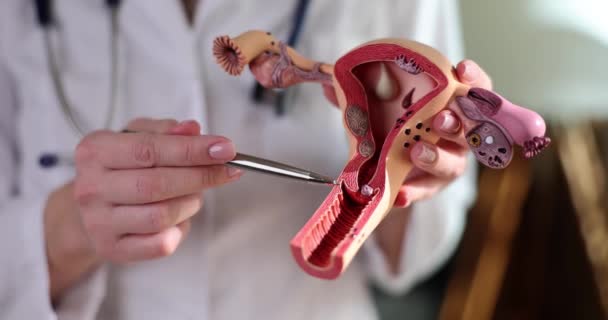 婦人科医は子宮のモデルに子宮の構造を示しています 女性生殖器系の解剖学的構造と疾患の治療 — ストック動画