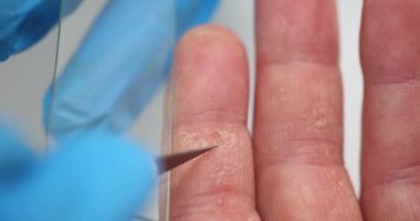 Laboratuvar asistanı dermatolog hasta çatlak deri örneği alıyor. Hasta sorunlu cildin incelenmesi