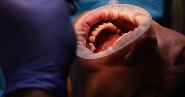 Οδοντίατρος Βουρτσίζει Δόντια Των Ασθενών Τοποθέτηση Και Καθαρισμός Δοντιών — Αρχείο Βίντεο