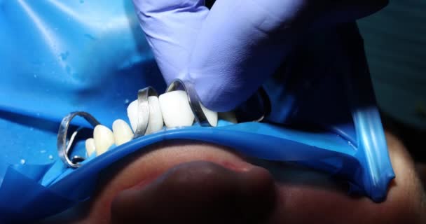 戴橡胶手套的牙科医生修理在职病人的牙桥 专科医生在牙科诊所为病人献上美丽的笑容 — 图库视频影像