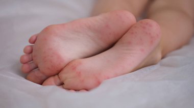 Eczema is an irritation caused by an allergic lesion of skin of feet in child. Infectious skin diseases in children