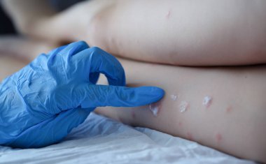 Lastik eldivenli doktor, çocuğun yakın plan kırmızı kızarıklığına krem sürüyor. Çocuk konseptinde böcek ısırıklarını tedavi etmek