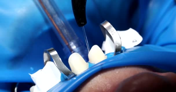 Zubař Připravuje Ženské Zuby Pro Instalaci Keramických Dýh Korunek Lékař — Stock video