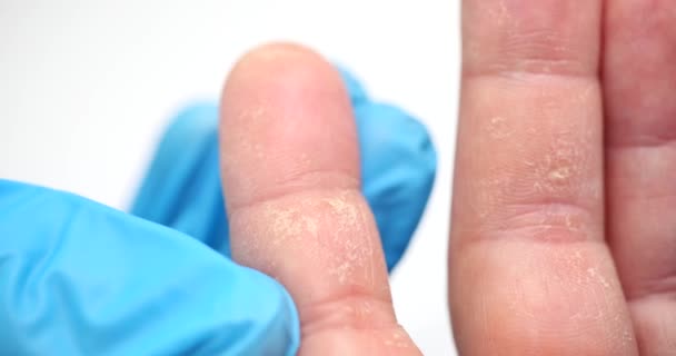 Suche Ręce Złuszczanie Skóry Dłoniach Palcach Alergia Chemiczna Zapalenie Skóry — Wideo stockowe