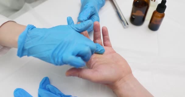Dokter Cosmetoloog Brengt Helende Zalf Aan Patiëntenhand Behandelen Huidbehandeling Psoriasis — Stockvideo