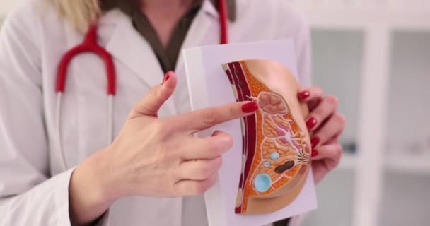 Nőgyógyász Elmagyarázza Betegség Emlőmirigyek Segítségével Anatómiai Modell Mell Emlőmirigyek Betegségei — Stock videók