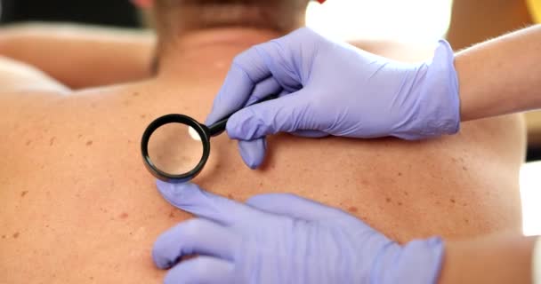 皮膚科医は 拡大鏡で成人の皮膚の成長を検査し 皮膚癌を診断する 血管腫 アンジョーマ パピローマ モール — ストック動画