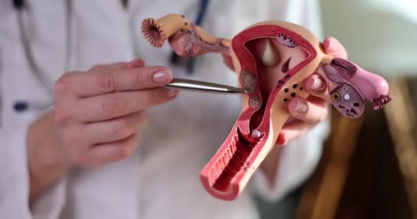 Doctor Holding Model Uterus Ovaries Ovarian Cervical Cancer Cervical Disorder — Stock Video