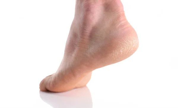 Die Ferse Des Fußes Mit Schlechter Haut Ist Mit Rissen — Stockfoto