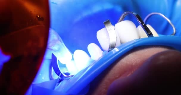 牙科医生在牙科诊所使用紫外光灯在牙齿上固定女性牙龈和陶瓷冠 牙科治疗 — 图库视频影像