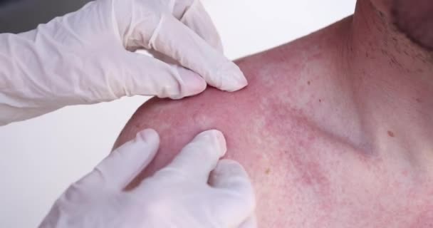 Doktor Rukavicích Vyšetřuje Muže Který Spálenou Kůži Ramenou Zádech Dermatolog — Stock video