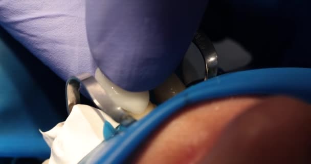 Tandläkare Blå Gummihandskar Behandlar Patienten Tänder Bron Professionell Läkare Skapar — Stockvideo