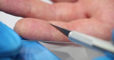 Muayene için hastanın kırık parmak derisinden örnek alan bir asistan. Laboratuvar bıçağı kullanan araştırmacılar yavaş çekimde küçük bir örnek yakaladılar.