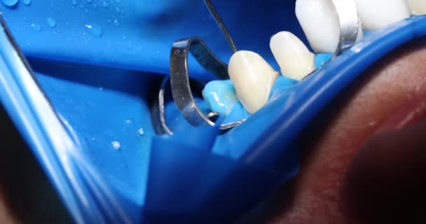 Dentista Aplica Gel Azul Dente Antes Instalar Folheados Serviços Odontológicos — Vídeo de Stock