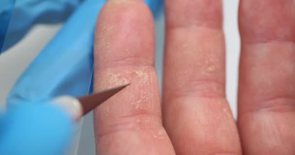 의사는 클로즈업을 트위저로 피부를 긁는다 건선과 습진을 손가락 — 비디오
