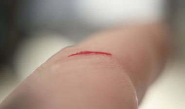 Cildinde kanla kesilmiş. Kan testi araştırma konsepti