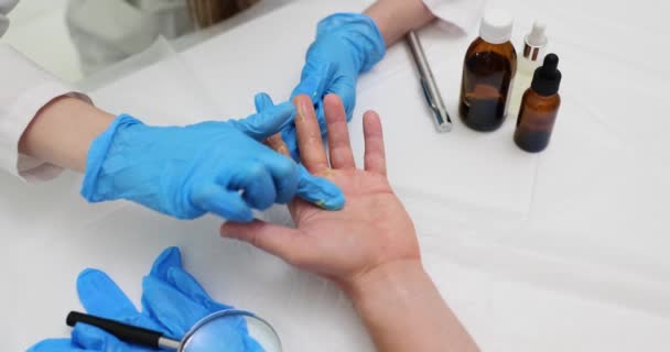 Läkaren Applicerar Salva Patientens Handflata Bränn Hudbehandling — Stockvideo