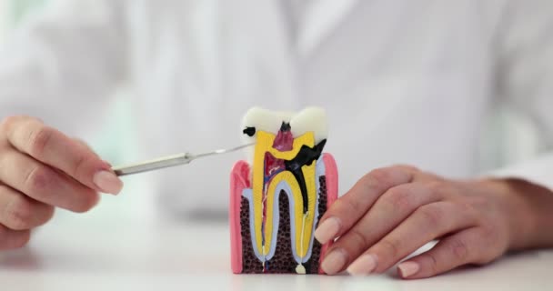 Dientes Con Dientes Dentista Muy Enfermos Dañados Caries Enfermedad Las — Vídeo de stock