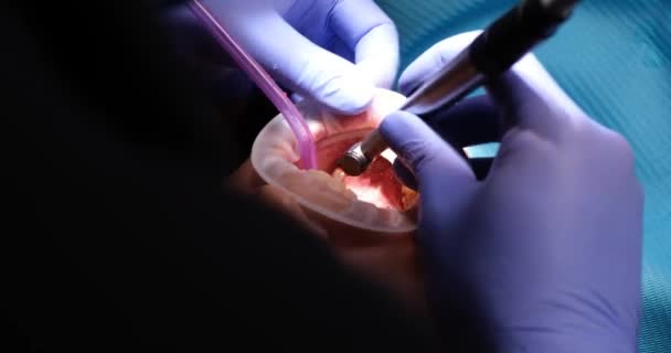 牙医从牙齿上摘除牙垢 探访专业牙科诊所 — 图库视频影像