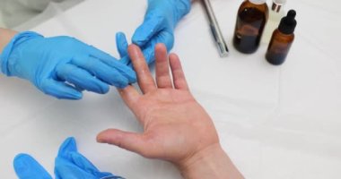 Doktor eldeki nasırları muayene eder ve cilde merhem sürer. Dermatologla randevusu olan el derisi sorunu olan adam klinikte.