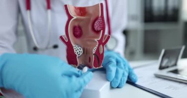 Proktolog doktor, rektum fitilini insan rektumuna yakın çekim 4K yavaş çekim yapay modeline sokuyor. Hemoroit tedavi kavramı