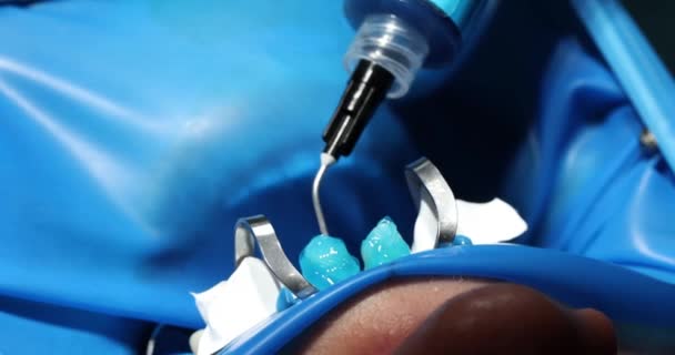Tandläkare Blå Gummihandskar Behandlar Patient Tandbro Professionell Läkare Skapar Form — Stockvideo