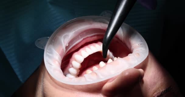 Doktor Dişçi Hasta Ağız Boşluğunu Kaplamalarla Inceliyor Modern Dişçiliğe Kaplama — Stok video