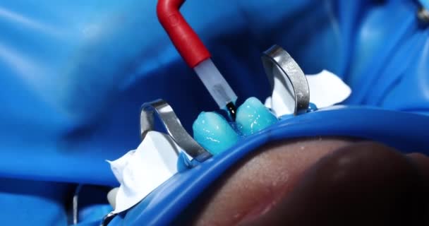 牙科医生在牙龈表面和牙齿之间使用保护性光聚合物凝胶 安装牙刷 — 图库视频影像