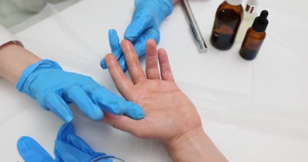 Dermatólogo Aplica Ungüento Palma Del Paciente Tratamiento Quemaduras Cutáneas Psoriasis — Vídeo de stock