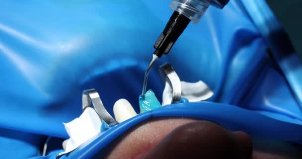 Стоматолог Наносит Гель Зуб Закрепить Шпон Коронку Пленку Концепция Имплантации — стоковое видео