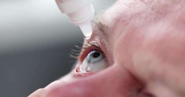 Человек Закапывает Глазные Капли Глаза Заболевания Глаз Концепция Лечения — стоковое видео