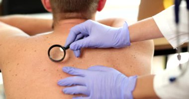 Dermatolog, klinikte büyüteç takan bir hastanın doğum lekesini ve doğum lekesini inceliyor. Benlerin ve neoplazmaların dermoskopisi