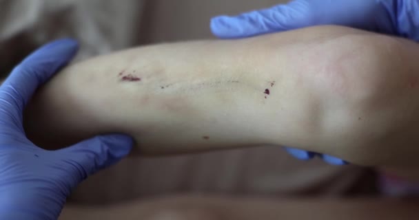 Lekarz Przeprowadza Badania Lekarskie Nogi Dziecka Zadrapaniami Ranami Leczenie Ran — Wideo stockowe