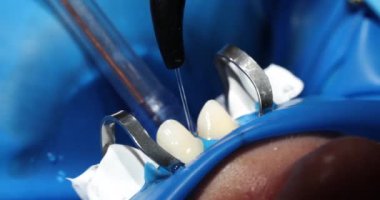 Hasta ağzında diş temizleme işlemi. Dişlerini su ve tükürük püskürtücüsüyle temizle.