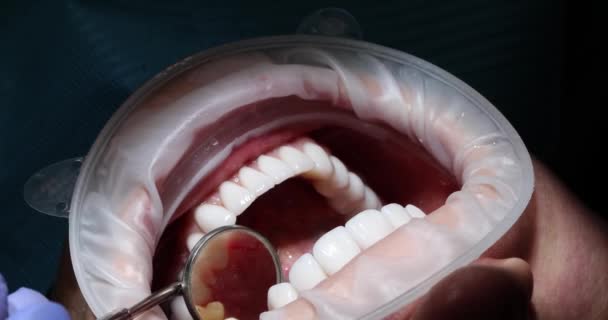 Zblízka Otevřených Úst Pacienta Během Ústní Prohlídky Zrcadlem Zubního Lékaře — Stock video