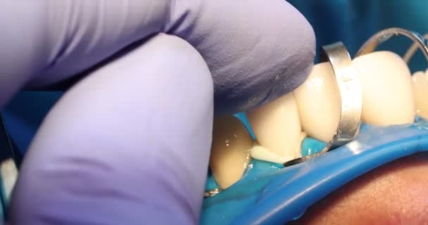 Zubní Péče Proces Instalace Dýh Instalace Dýh Zubním Lékařství — Stock video