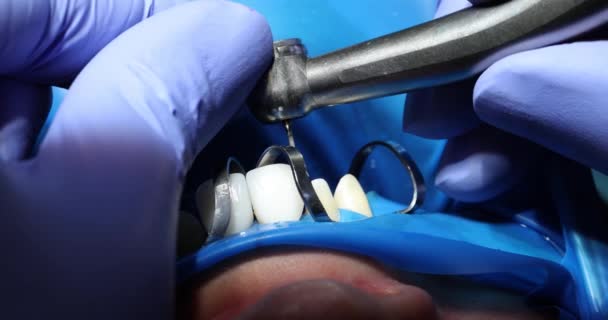 Tandarts Fixes Fineer Patiënt Tanden Met Behulp Van Metalen Beugels — Stockvideo